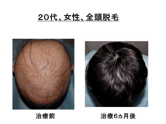 円形脱毛症　病院